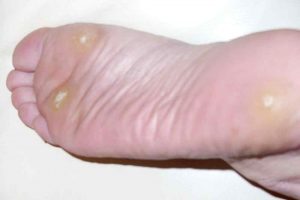 Warts Causes and Treatment