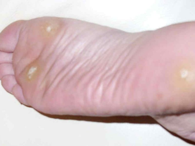 Warts Causes and Treatment
