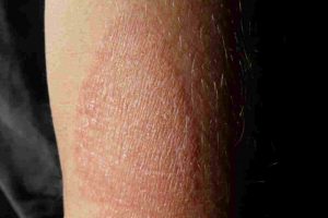 What is Meant by Eczema