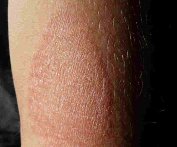 What is Meant by Eczema