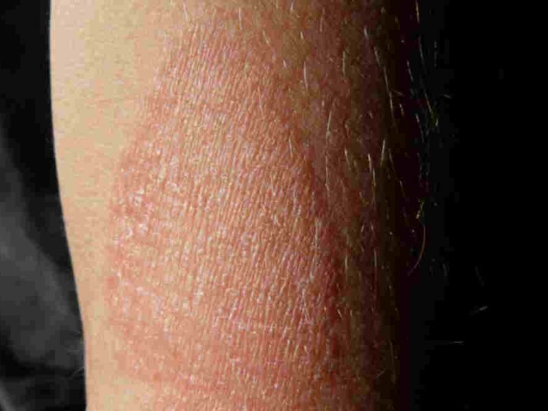 What is Meant by Eczema